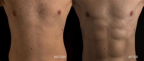 male liposuction miami|Mens Liposuction Miami 